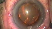 Iris Prolapse