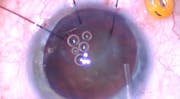 Capsular Block