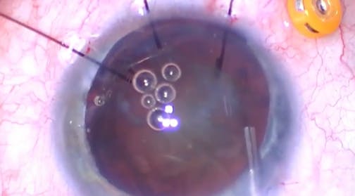 Capsular Block
