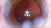 Acute Capsular Block
