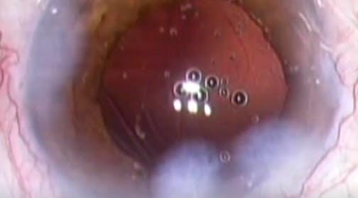 Acute Capsular Block