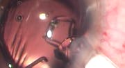 Injector Surprise