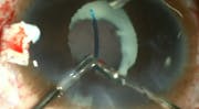 Aphakia With Microcornea