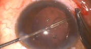 Retropupillary Claw