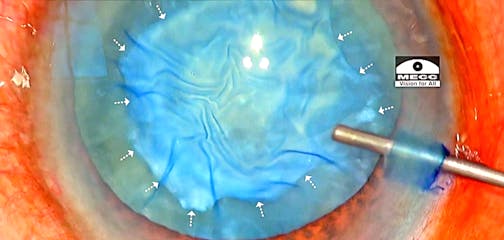 Calcified Plaque