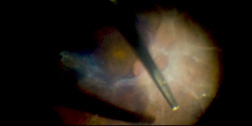 Unveiling the Macula: A Case of Taut Fibrovascular Tissue in Diabetic Retinopathy