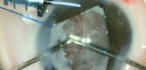 Surgery for Stage 5C Retinopathy of Prematurity