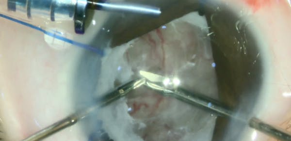 Surgery for ROP Stage 5C thumbnail