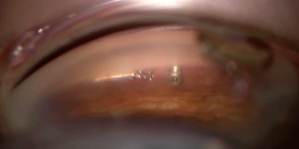 Using Multiple Technologies to Maximize Quality of Vision thumbnail