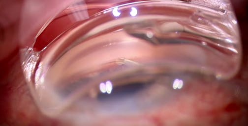 Standalone Interventional Glaucoma