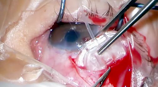 Ahmed Glaucoma Valve Implantation in Refractory Pediatric Glaucoma