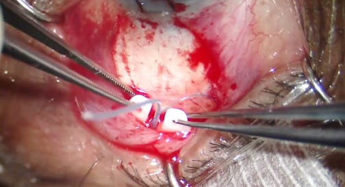 Ahmed ClearPath 350: Small Tube Tutorial