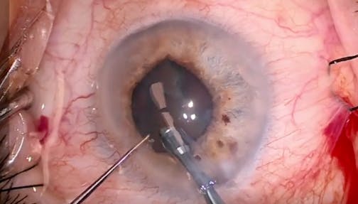 Managing a Small Pupil