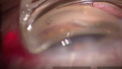 Pressurized Viscodelivery thumbnail