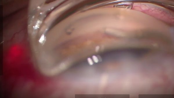 Pressurized Viscodelivery thumbnail