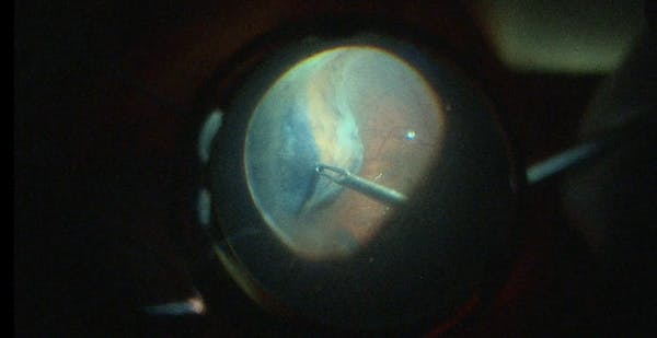 Retinectomy for Intrinsic PVR thumbnail