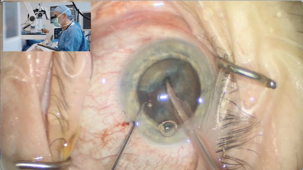 Operating at a More Physiological IOP thumbnail