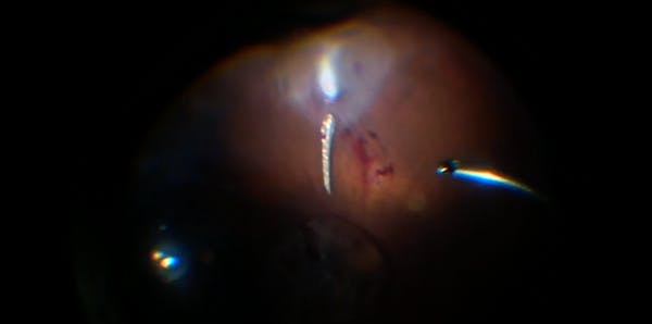 Removing a Metallic Intraocular Foreign Body thumbnail