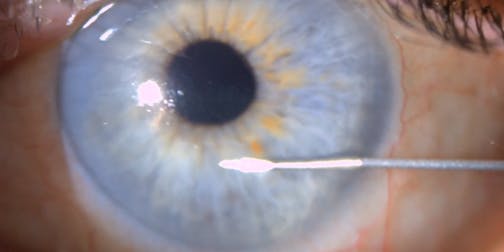 Case Files From the Office: Durysta Insertion