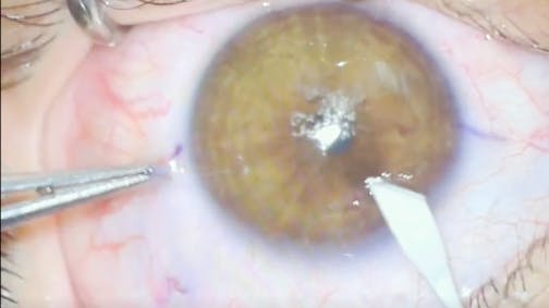 SMILE Complication Management