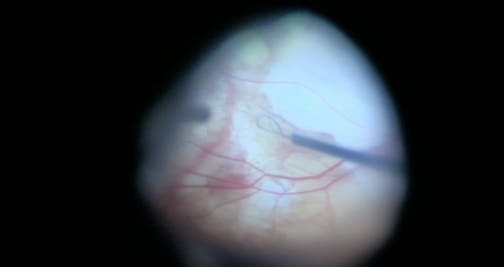 Chronic Full Thickness Macular Hole in a Highly Myopic Eye