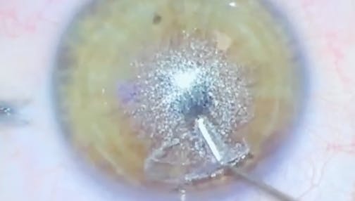 Real-Time SMILE Surgery