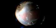 Temporary Keratoprosthesis-Assisted Retinal Detachment Repair