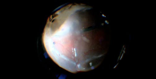 Temporary Keratoprosthesis-Assisted Retinal Detachment Repair