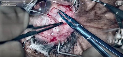 Technique for Implantation of ClearPath 250 ST