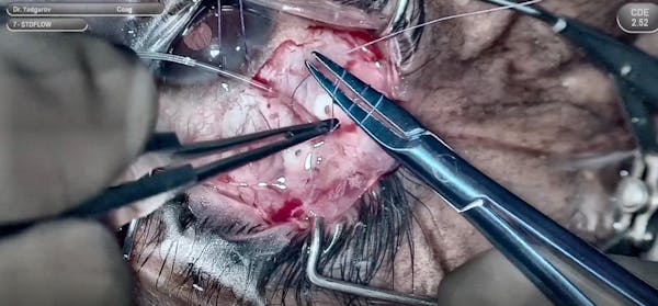 Technique for Implantation of ClearPath 250 ST thumbnail