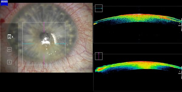 SMILE Pro With Intraoperative OCT Control thumbnail