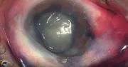 Concurrent UT-DSAEK and Phacoemulsification