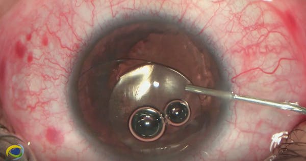 The Easiest-to-Solve IOL Dislocation thumbnail