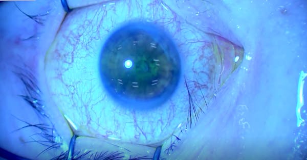 A Better Prep: The Fornix Washer thumbnail