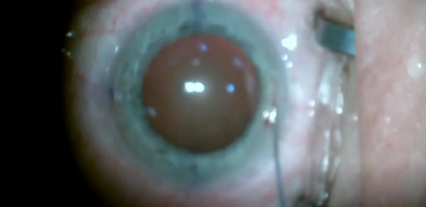 ArcDUO for AK or LRI thumbnail