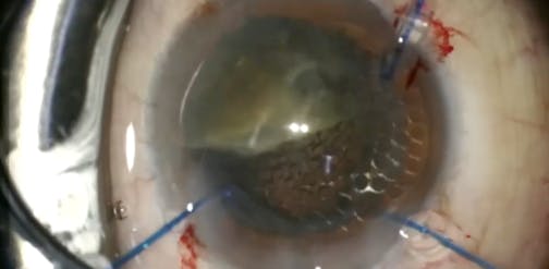 Safety Net Preventing Nucleus Drop