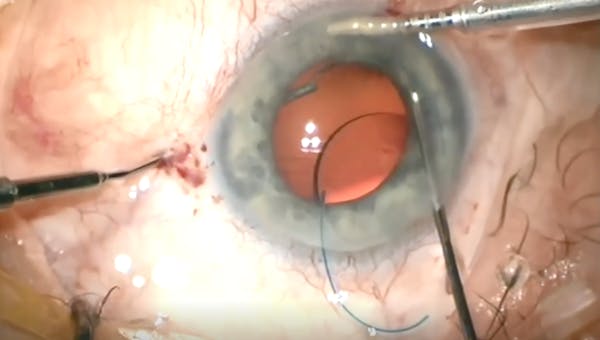 Needle Forceps: Intrascleral Fixation thumbnail