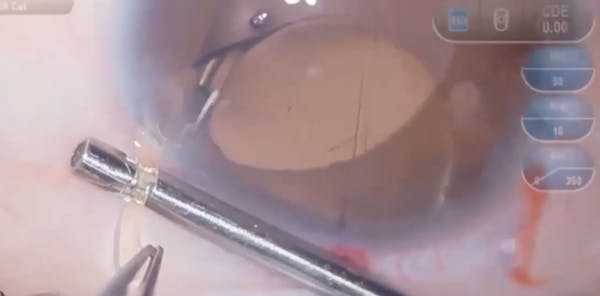 Haptic Micropunch for Flanged Fixation thumbnail