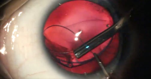 CTR Eyelet for Flanged Fixation