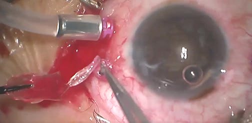 Explantation: Lens Grabber Forceps