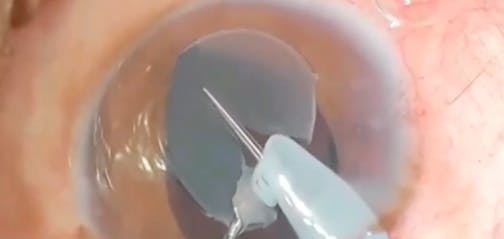 IOL Cutting Tip