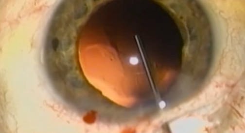 Novel Surgical Lenses