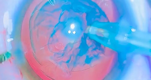 Posterior Polar Cataract