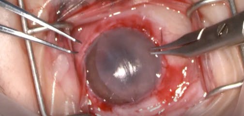 Double-Layer Amniotic Membrane Transplantation in Limbal Stem Cell Deficiency With Severe Corneal Conjunctivalization