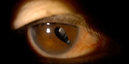 A Traumatically Dislocated but Perfectly Centered Multifocal IOL