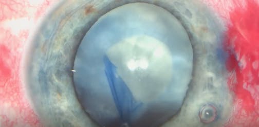 White Cataract After Posterior Capsule Rupture