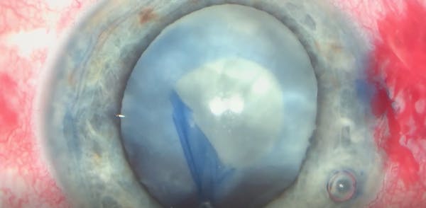 White Cataract After Posterior Capsule Rupture thumbnail
