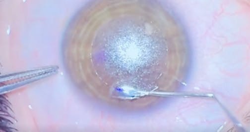 Stages of Lenticule Surgery With the SMILE Pro Device