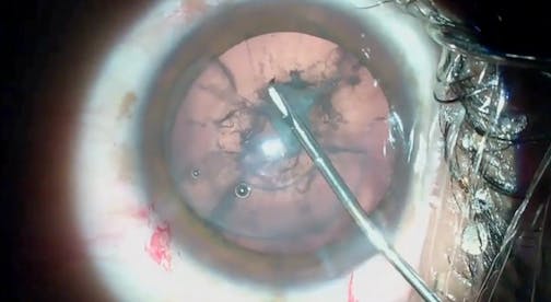 A Staged Approach to Traumatic Cataract in Severe Corneal Ectasia