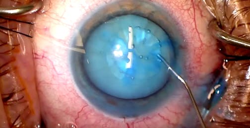 iTrack Blanching and White Cataract